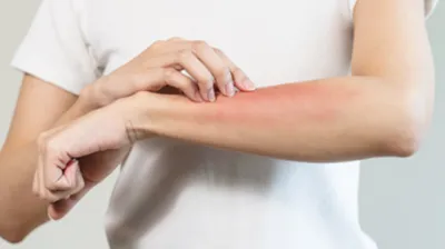 皮膚から始まる食物アレルギー 化粧品やゴム手袋がアレルギーのきっかけになる？