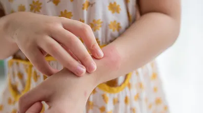 連続的に発症する子どものアレルギー、専門医への早期受診で予防を